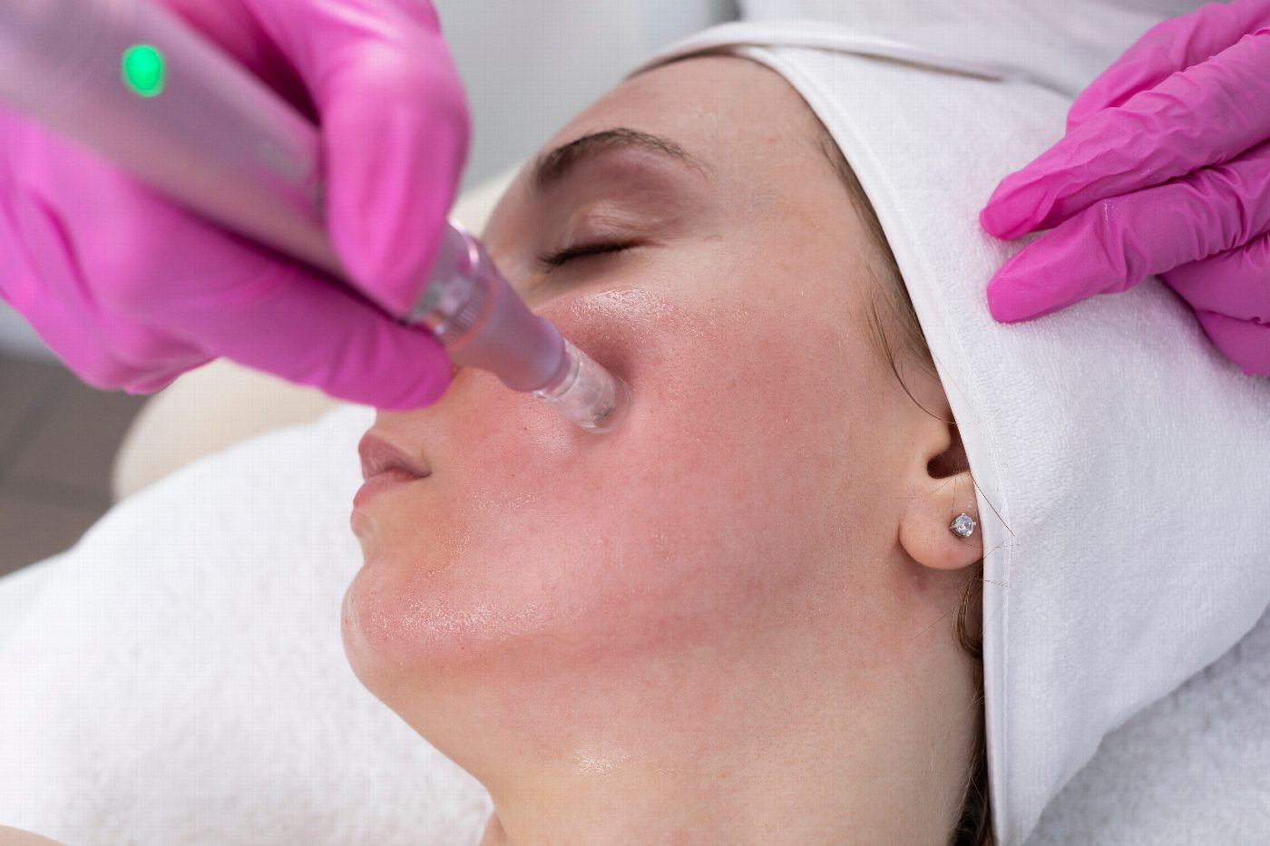 Microneedling-Behandlung im Gesicht
